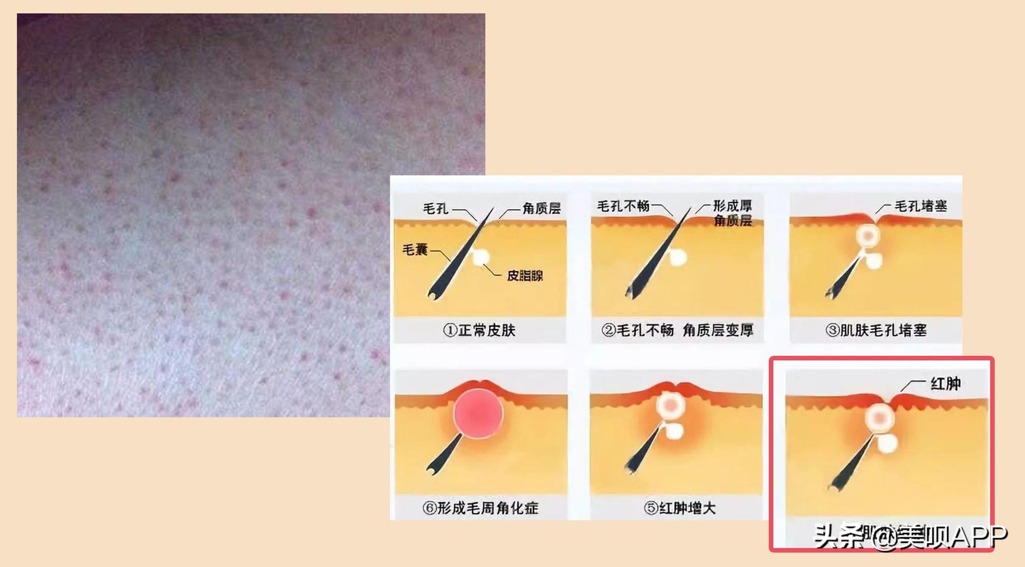 春季鸡皮肤大作战!去毛周角化也要分种类好吗?