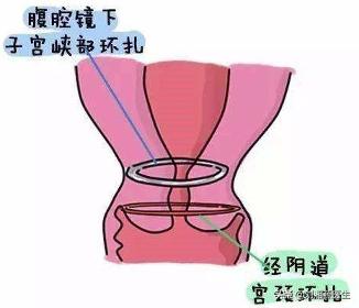 「免疫相关不良妊娠答疑解惑53」——宫颈机能不全