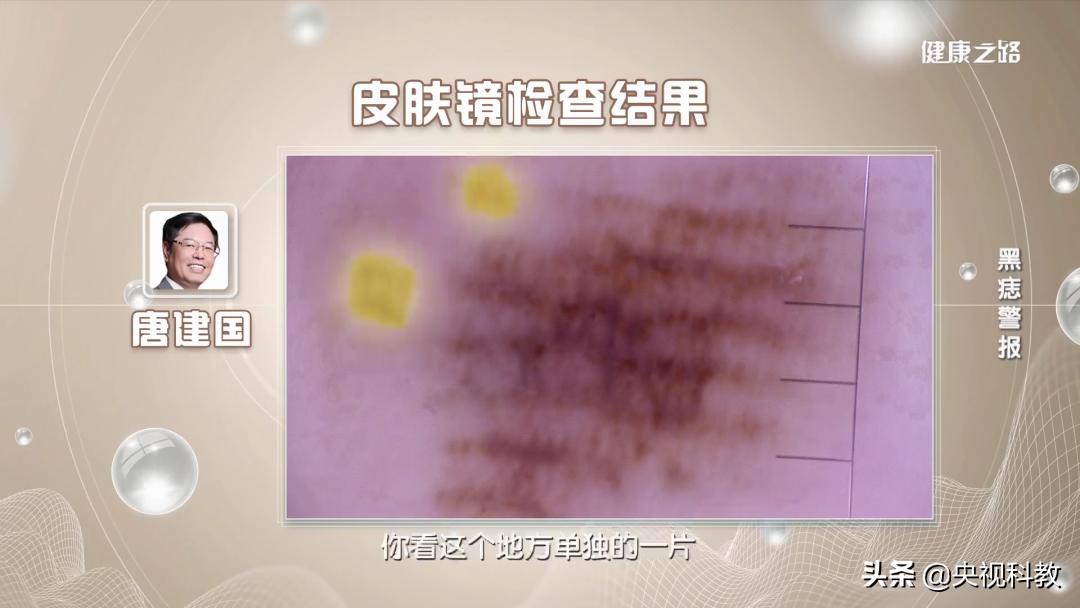 黑痣很容易恶变吗,身上黑痣出现什么状况有癌变发生