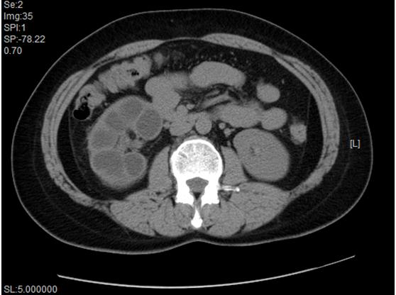 反复尿路感染警惕什么疾病,老是尿路感染会有结核吗