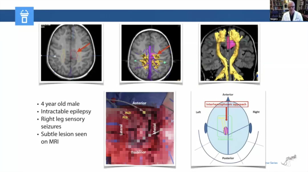 儿童癫痫治愈的真实案例,儿童难治性癫痫有哪些