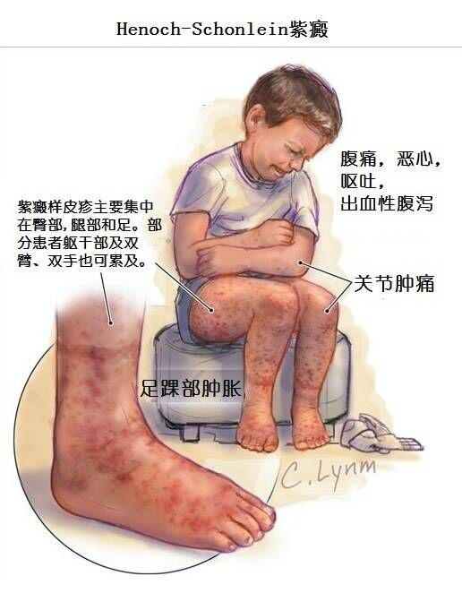 过敏性紫癜引起肾炎怎样预防,怎样预防过敏性紫癜复发