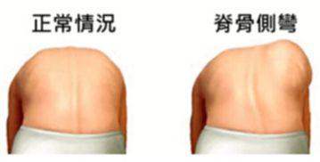 怎么知道脊柱侧弯的危害和症状,造成脊柱侧弯的原因主要是什么