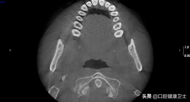 牙齿劈裂怎么处理,牙齿劈裂的补救方法