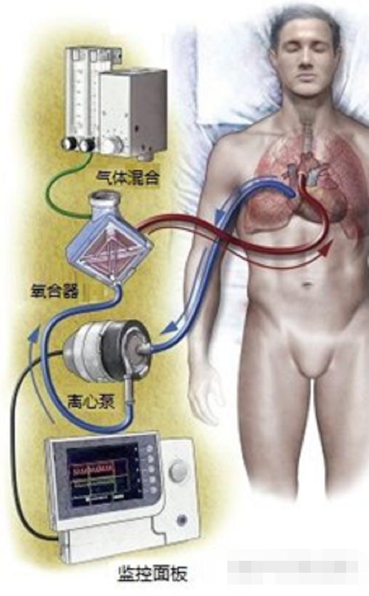 中国哪些呼吸机遭多国疯抢,中国呼吸机紧缺视频