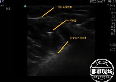 缝衣针剔牙针尖断了,缝衣针针头断了