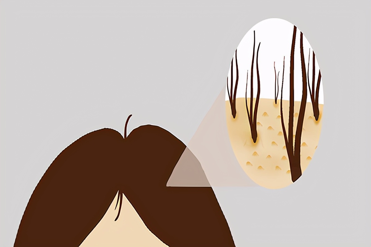 头皮和后背起疙瘩瘙痒是怎么回事,头皮上有个小疙瘩抠掉还会长