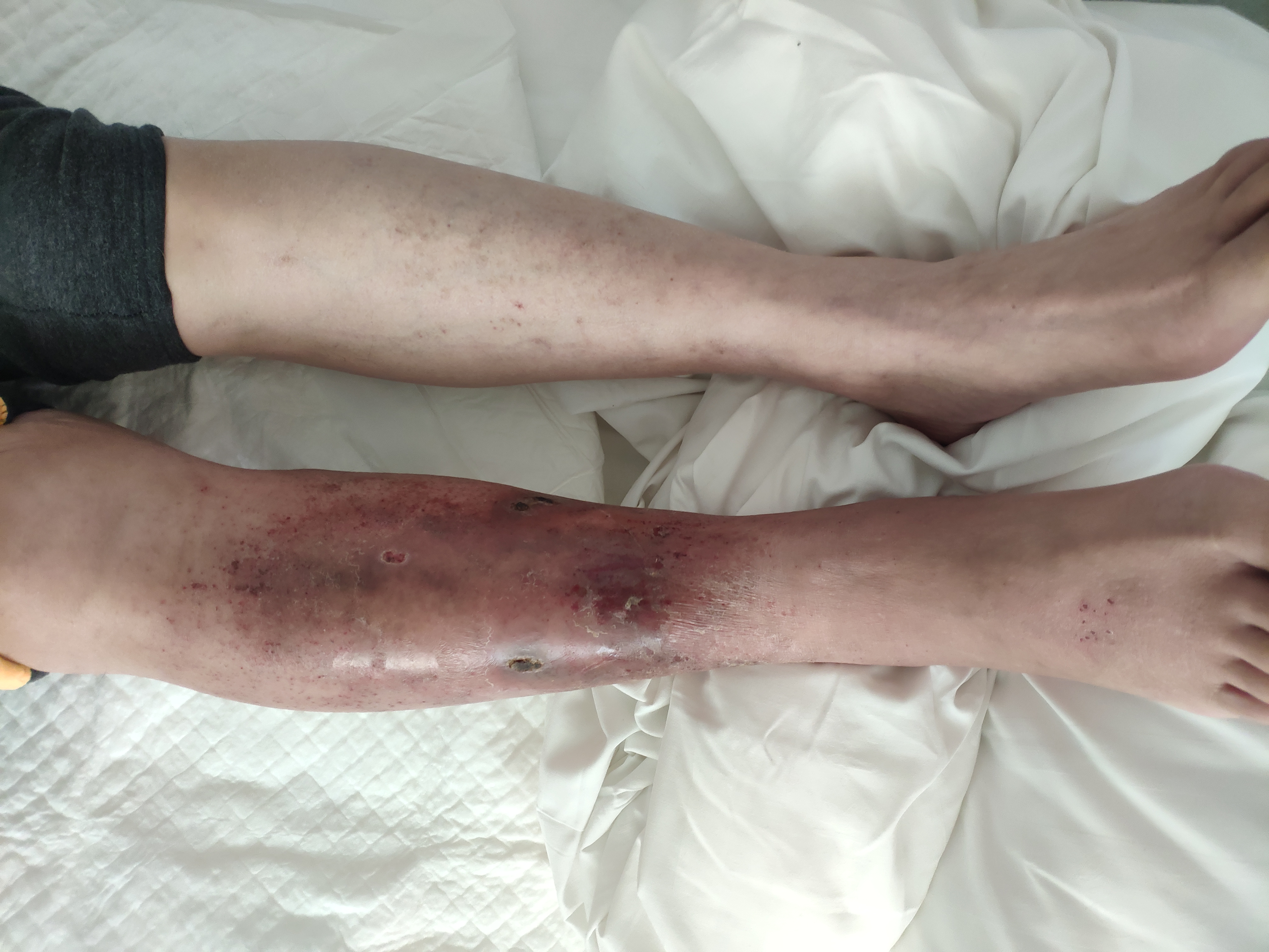 皮肤溃烂挂骨外科主要看什么病,皮肤溃烂看中医还是西医