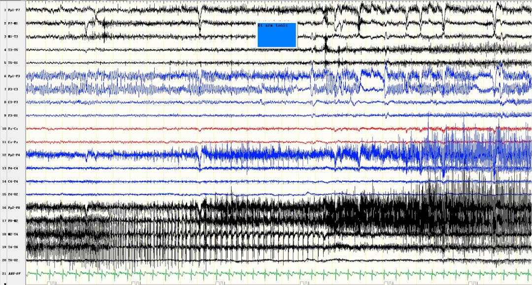吃药引起的癫痫停药后会好吗,药物控制不住癫痫可以停药吗