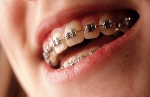 牙齿整齐不仅仅是为了好看吗,牙齿整齐咬合不对需要戴牙套吗