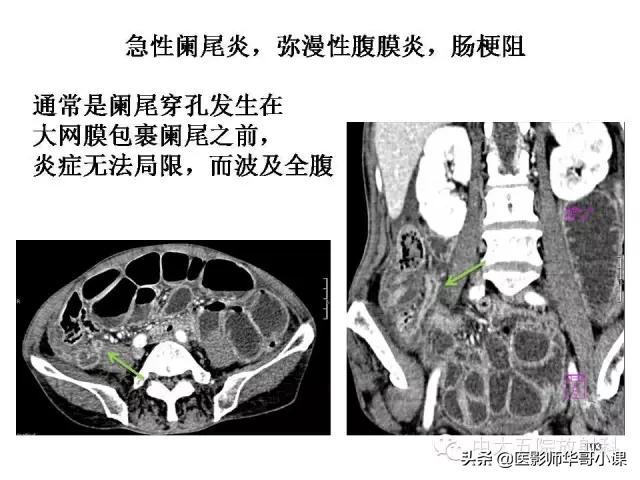 阑尾炎课件,阑尾炎的超声课件
