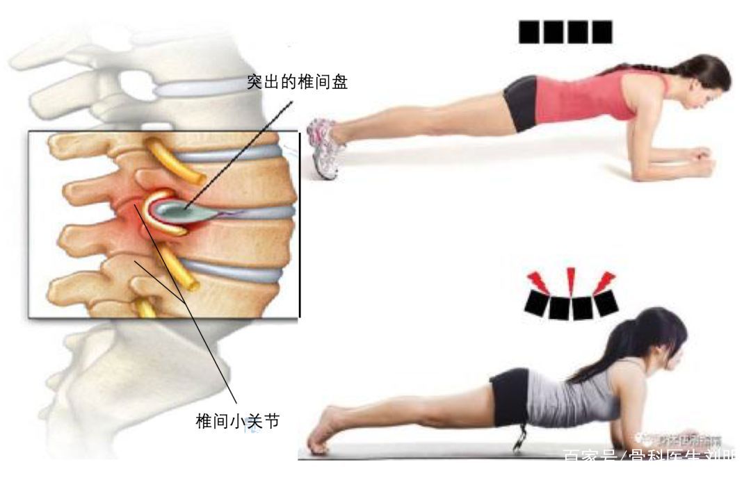 平板支撑为什么腰痛,平板支撑为什么会肩痛