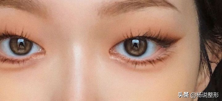 整形医生科普割双眼皮必看攻略,割双眼皮一定好看吗