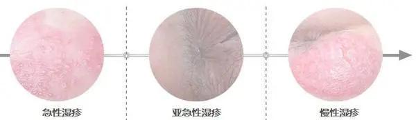 湿疹反复怎么根除吃中药,湿疹家庭自我治疗