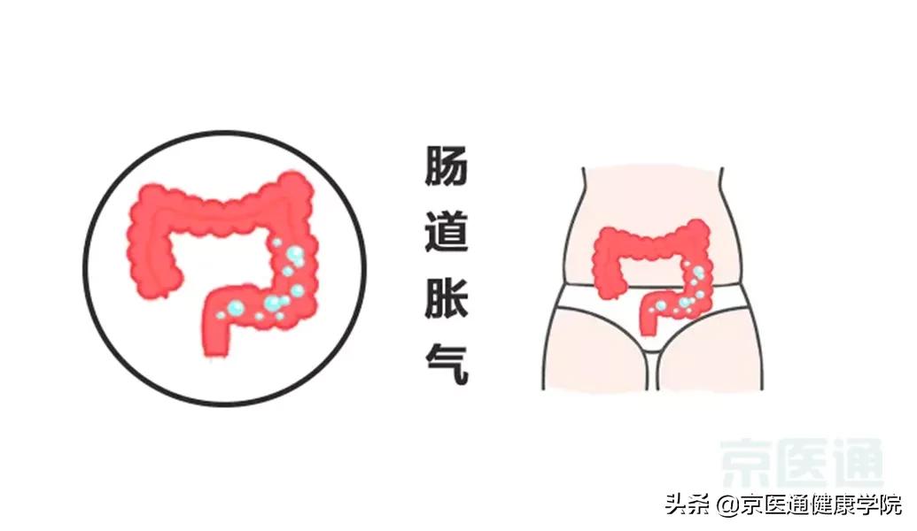 一分钟解决胃肠胀气的方法,胃肠道胀气做什么动作来缓解