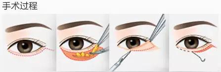 北大整形教授张宗学,张宗学博士微整形