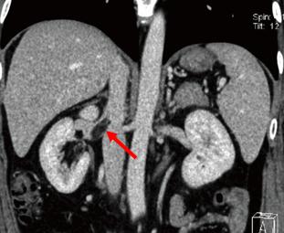肾上长错构瘤怎么办,肾错构瘤是什么意思