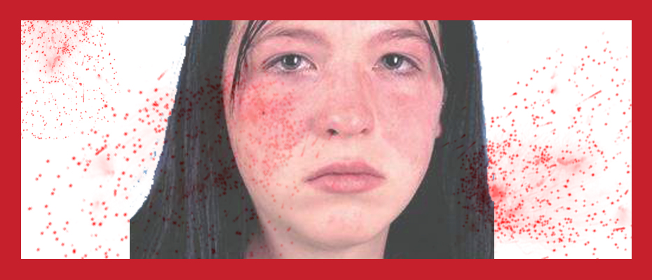 被屠呦呦团队盯上的红斑狼疮到底是什么病？致死但5年生存率达90%