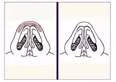 鼻整形后出现肿胀,鼻子整形后假体外露是手术失败吗
