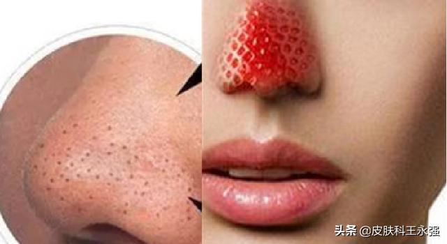 鼻子上挤出来黄色丝状物怎么解决,鼻子上挤出的白色状物到底是啥