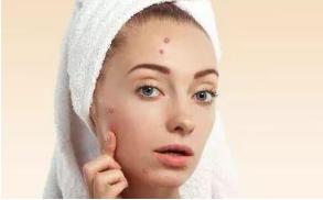 一直长痘痘反反复复怎么办,总是爱长痘痘用什么管用