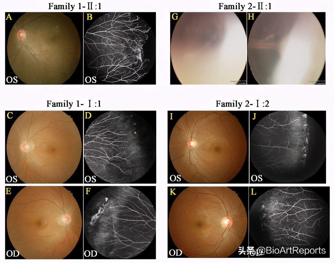 家族性视网膜病变是怎么回事,基因治疗视网膜病变最新进展