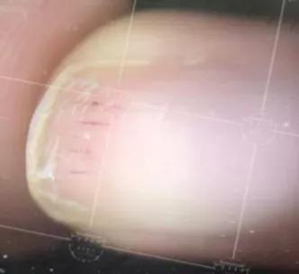 美甲会不会导致灰指甲,灰指甲脱甲液致癌