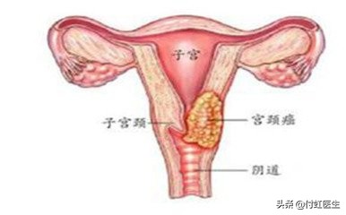 辟谣：房事过度宫颈肥大？