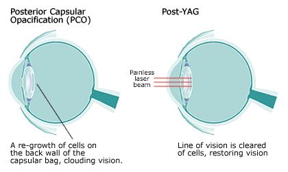 为什么有人说白内障术后会复发,白内障术后复发的原因有哪些