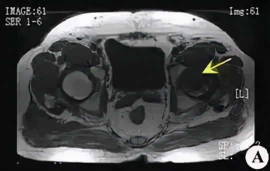 股骨头坏死和腰间盘突出症状区别,椎间盘突出和股骨头坏死症状区别