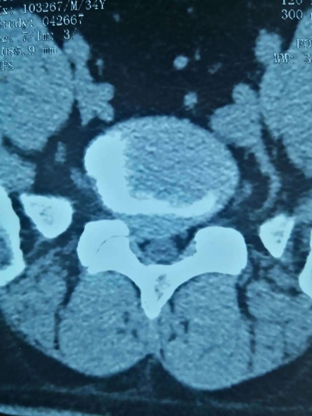 陕西椎间孔镜手术最好的医院,椎间孔镜手术陕西哪个医院做得好