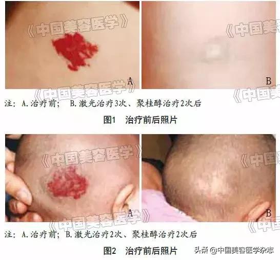 聚桂醇治疗血管畸形多久看见效果,聚桂醇治疗血管畸形的疗效