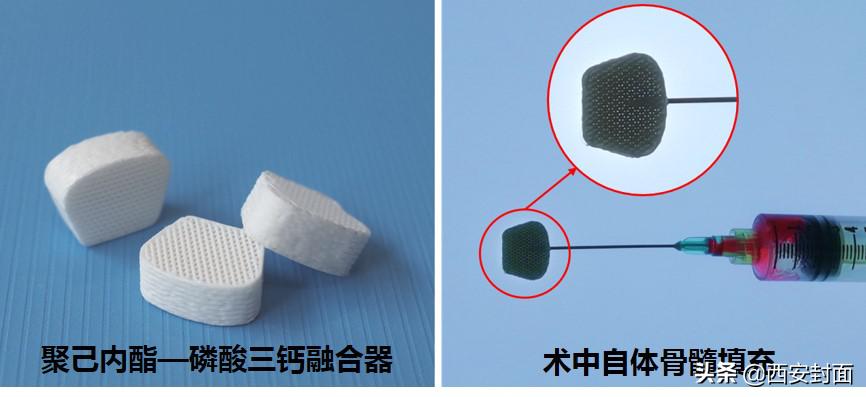 椎体间融合器,可吸收椎间融合器
