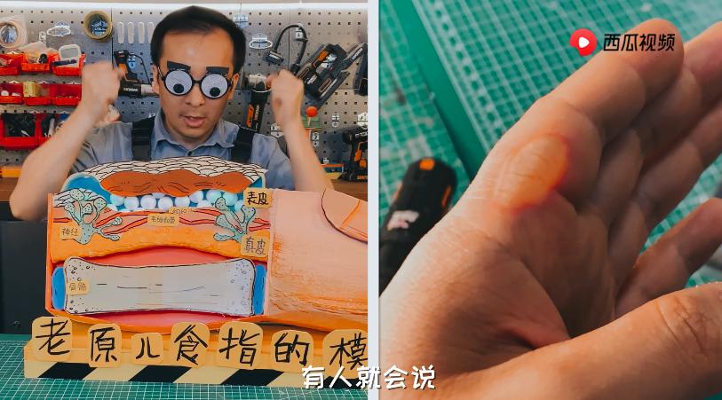 深二度烫伤和浅二度烫伤对比图片,烫伤的泡变暗红色