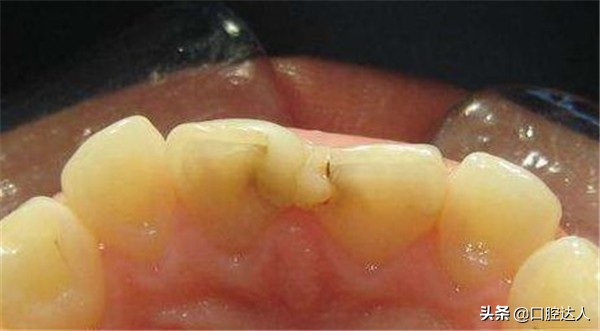 不补牙齿有问题吗,不补牙齿后牙齿会怎样