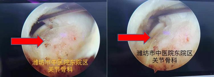 潍坊哪个医院看肩周炎比较好,潍坊中医院颈肩腰腿疼专家