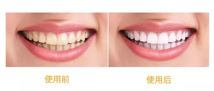 一口黄牙竟让形象尽毁！‘到手香’帮你重新找回自信！大胆开笑