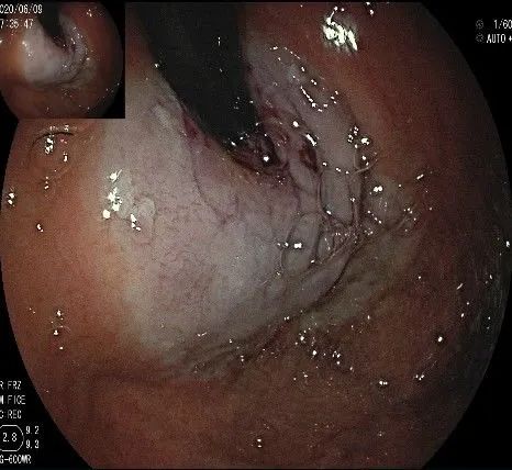 贲门隆起性病变影像,贲门溃疡隆起性病变