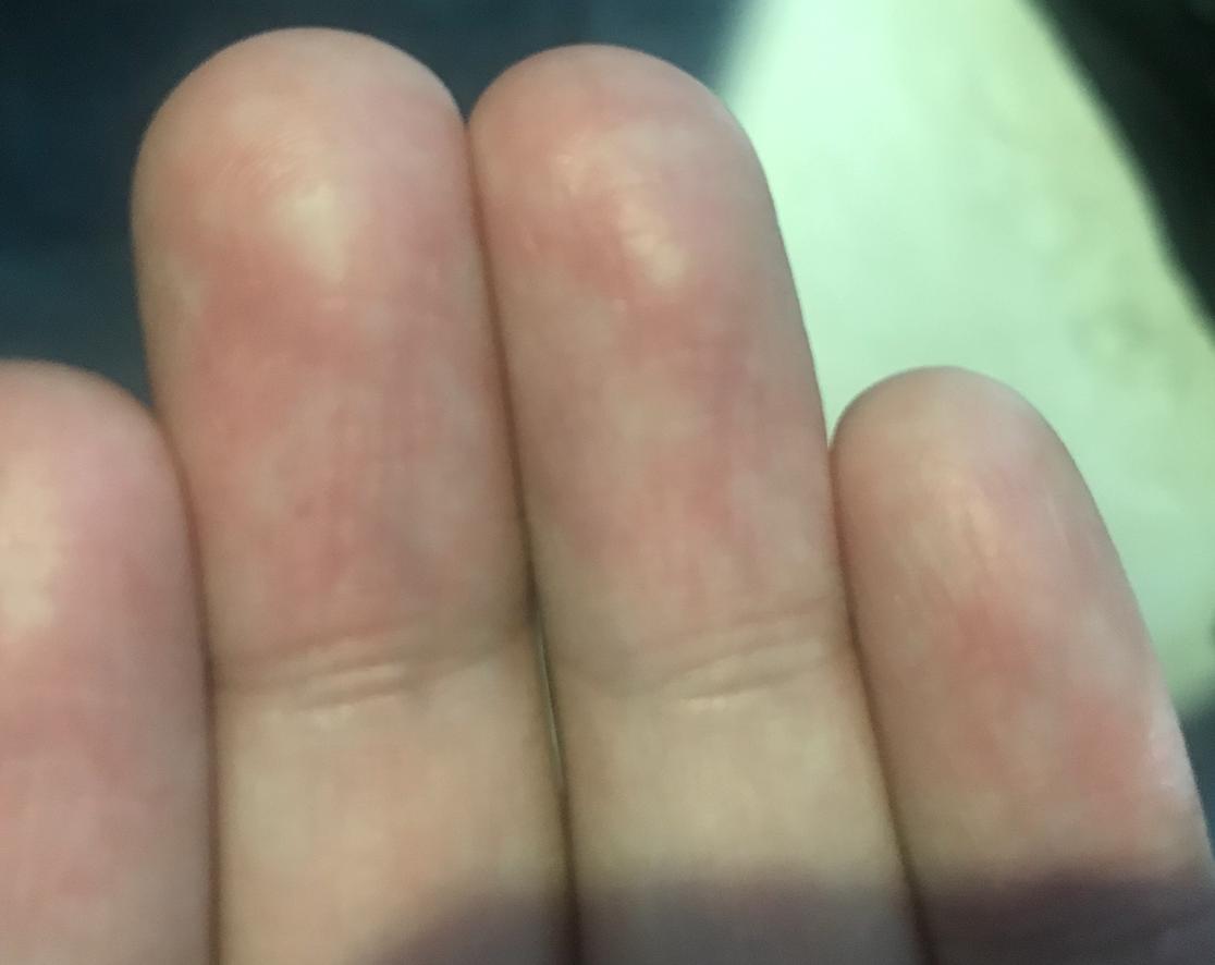 手指肚干瘪脱皮有褶皱原因,手指指腹干瘪起皱脱皮怎么办