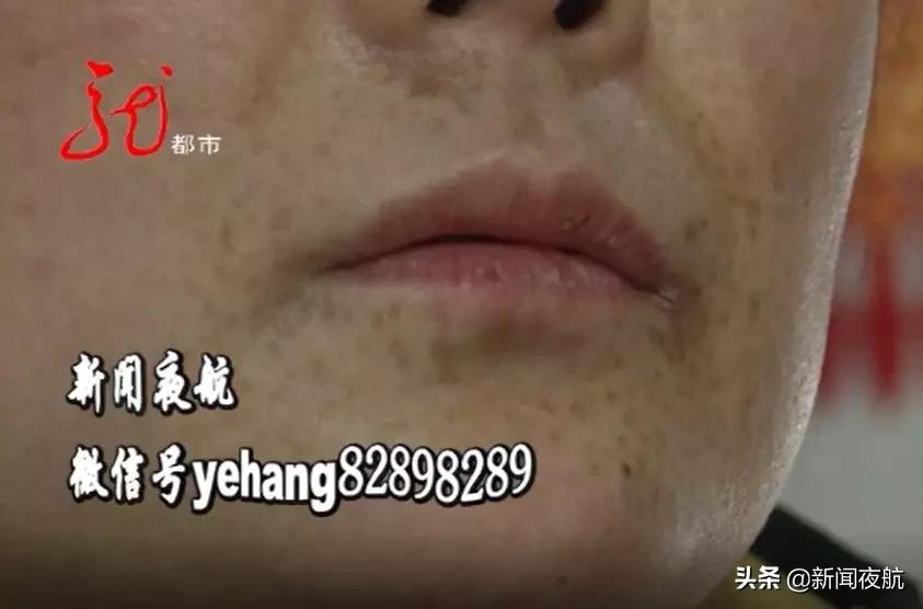 在车库里做液氮祛斑?斑点没去掉,脸都花了!这属于正常现象,还要继续治疗?液氮祛斑,是你想做就能做的吗