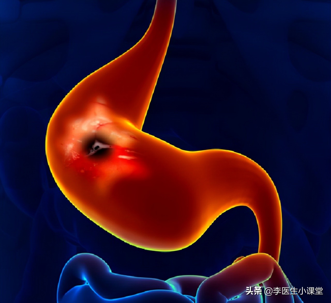 阿司匹林，长期吃容易出血！医生：教你3个办法，减少消化道出血