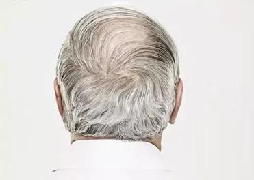 肠上皮化生是癌症吗,肠上皮化生什么意思