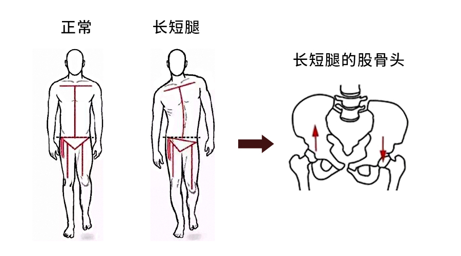 股骨头坏死岔不开腿是咋回事,股骨头坏死不能内旋的原因
