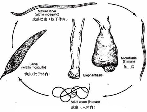 丝虫病大象腿后续,丝虫病在腿上