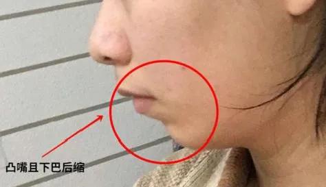 脸大下垂严重怎么改善,凸嘴引起的脸大怎么改善