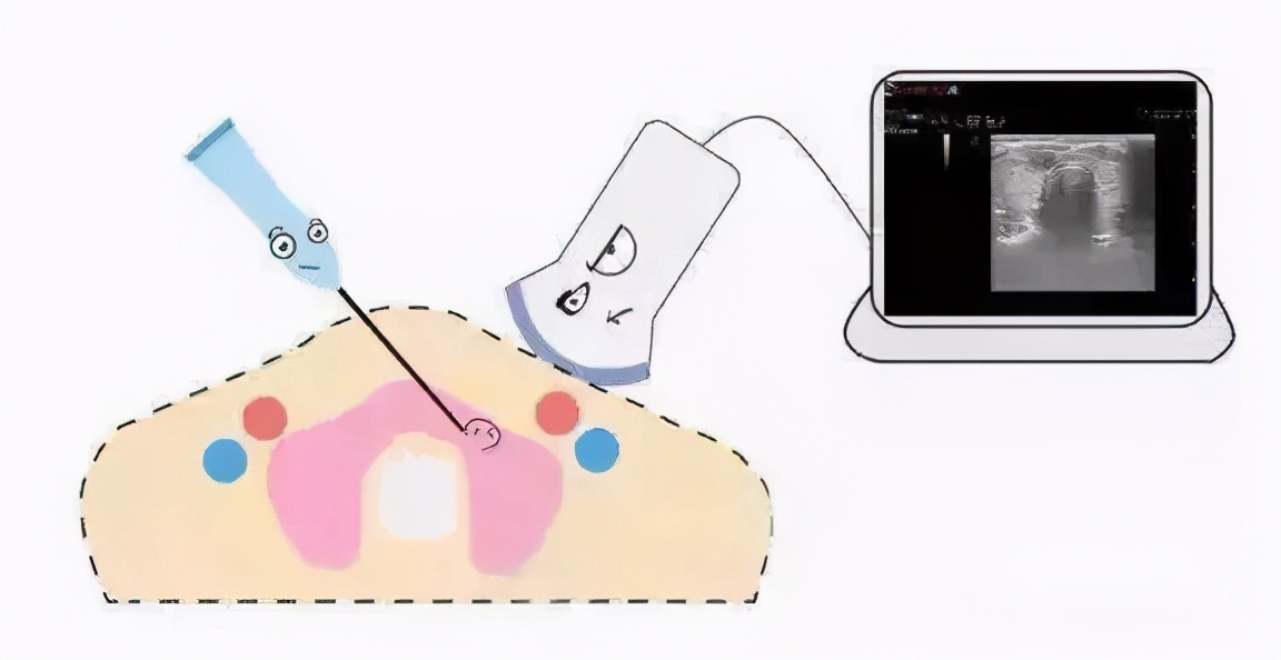 20多岁甲状腺结节,20岁得了甲状腺结节