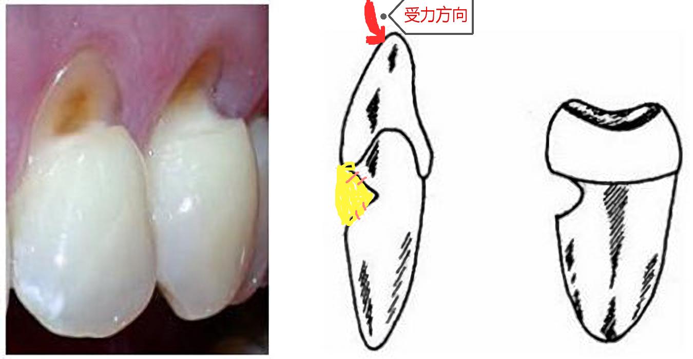 牙齿边缘有缺口图片,牙齿上面缺口