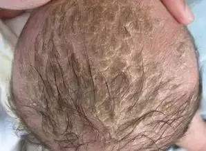 宝宝患脂溢性皮炎，妈妈不用着急