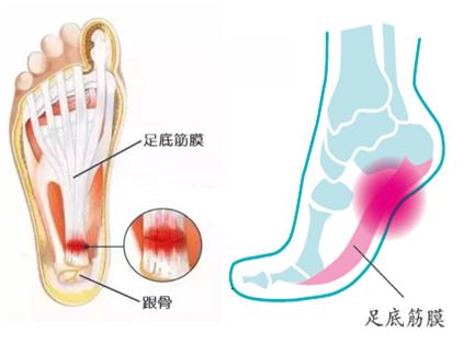 脚底疼痛警惕四种病,脚底疼痛怎么处理