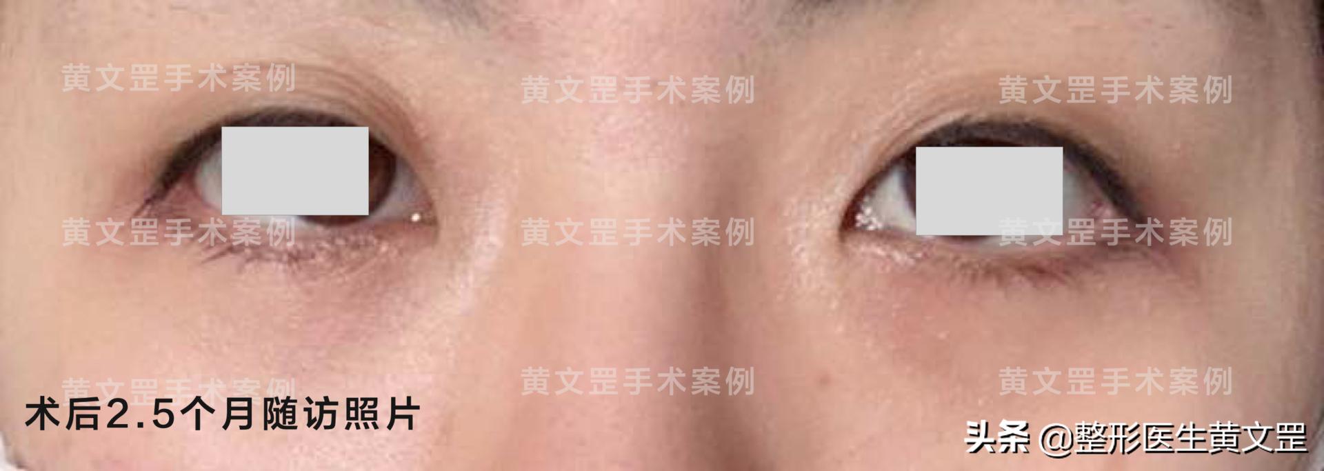 「黄文罡案例」去除眼袋和泪沟，让你年轻10岁